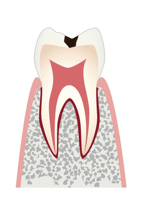 C1：エナメル質に小さな穴が空いたむし歯