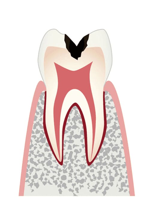 C2：歯の内部まで進行したむし歯