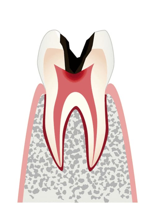 C3：神経まで進行したむし歯