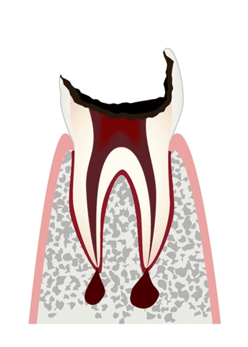 C4：歯根まで進行したむし歯